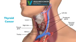 Thyroid Cancer - What Is It? What are the Symptoms and Treatment? Head and Neck Cancer