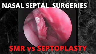 054. Surgeries of Nasal Septum; Septoplasty Vs SMR  #nosejob  #surgeryeducation