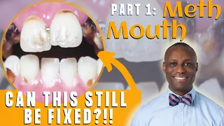 Meth Mouth (Crank Decay)