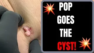 POP GOES THE CYST!