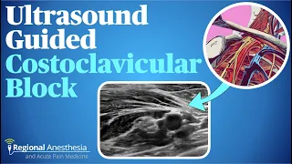 Costoclavicular Brachial Plexus Block