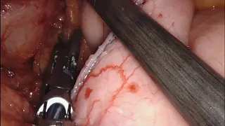 Robotic RYGB Linear Stapled 2x with Minimal Edits 31 min