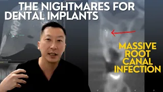 Failed Root Canals and Why They can be Nightmares for Dental Implants