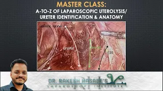 #49: MASTER CLASS: A-to-Z of Laparoscopic Ureterolysis/Ureter Identification & Anatomy (Voiceover)