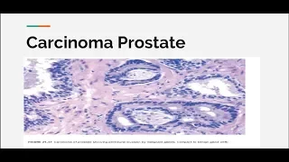 Carcinoma  prostate