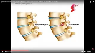 Межпозвонковая грыжа – это … Причины возникновения и методы лечения без лекарств