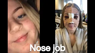 nose job check before and after Tiktok compilation challenge new nose