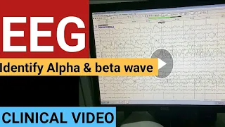 Normal EEG - identify Alpha & Beta wave