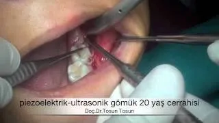 wisdom tooth operation by piezoelectric ultrasonic surgery