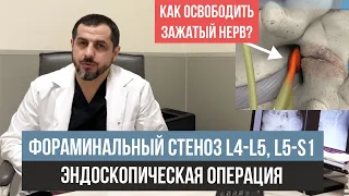 Лечение фораминального стеноза позвоночного канала L4 L5, L5 S1  Разбор МРТ поясничного отдела