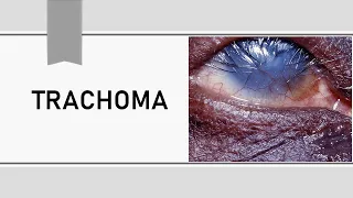 Trachoma Lecture