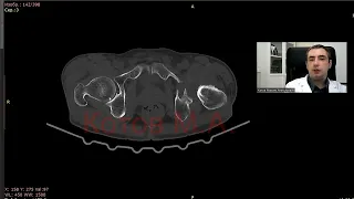 Асептический некроз головки бедренной кости. Ролик №70