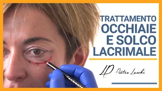 Medicina Estetica: OCCHIAIE e CONTORNO OCCHI - Chirurgo Plastico Modena Bologna Milano