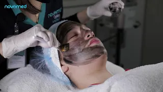 Smooth and rejuvenated skin with Fotona Carbon Facial at Novomed