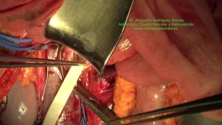 Cirugía en Sd Cascanueces  Trasposición de la Vena Renal Izquierda