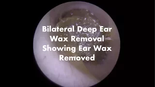 Quick Ear Wax Removal 2 Ears In Under 2 Mins - Ep 15