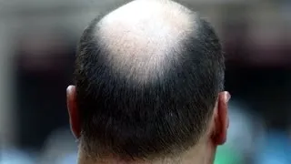 Are doctors closer to curing baldness?
