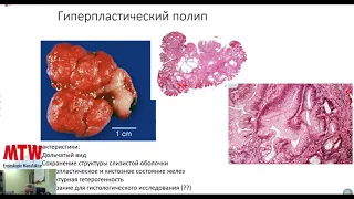 Полиповидные образования желудка. Морфологические типы, диф. диагностика, онкологические аспекты.
