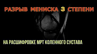 Расшифровка МРТ с РАЗРЫВОМ МЕДИАЛЬНОГО МЕНИСКА 3 степени коленного сустава