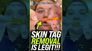 Skin Tag Removal is LEGIT 😱 #shorts