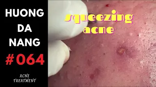 #064 | Squeezing acne for a girl | Nặn mụn cho em gái | Hương Đà Nẵng