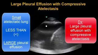Lung Ultrasound: Consolidation - Atelectasis or Pneumonia?