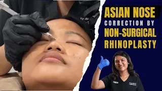 Nonsurgical Rhinoplasty in India /Mumbai | 15 minutes Nosejob in Mumbai (Live Procedure)