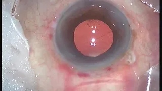 MSICS in different types of cataracts - Aravind way using irrigating vectis