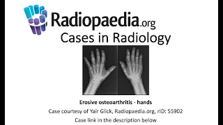 Erosive osteoarthritis (Radiopaedia.org) Cases in Radiology