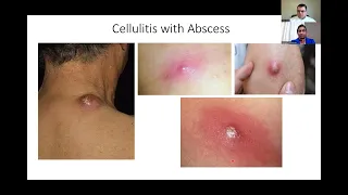 Diagnosis and Treatment of Cellulitis