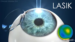 Todo lo que Debes Saber sobre la Cirugía Refractiva LASIK