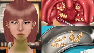 ASMR 10년된 냄새나는 편도결석 제거 애니메이션‼️ㅣ입냄새의 원인, 백태제거, 이비인후과 시뮬레이션