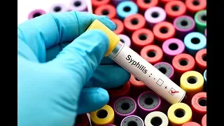 Outbreak called as syphilis rates jump in Alberta