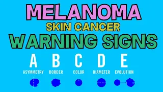 Melanoma Skin Cancer - Warning Signs - ABCDE Diagnostic Assessment