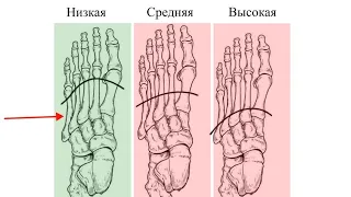 Изготовление индивидуальной стельки при ампутации пальцев или части стопы (по Шарпу- низкий уровень)