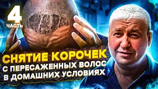 Снятие корочек с пересаженных волос в домашних условиях | 10 дней после трансплантации волос