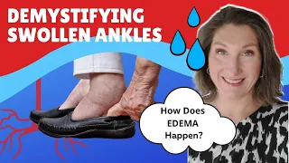 Swollen ankles? Demystifying EDEMA