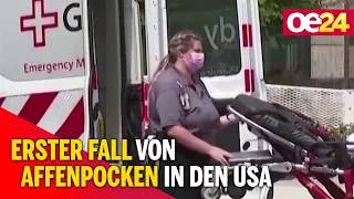 Erster Fall von Affenpocken in den USA