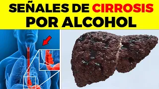 ASI EMPIEZA la CIRROSIS por Alcohol y nadie te lo dice, signos y síntomas de cirrosis por alcohol