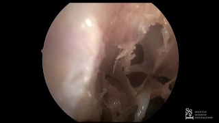 Lab Demo - Prosection: Lothrop Procedure Raymond Sacks, MD, FCS, FRACS