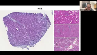 Dr.  Iago Pinal-Hernandez presents to TMA Men Managing Myositis Affinity Group January 2024