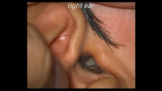 Earwax Impaction In Both Ears