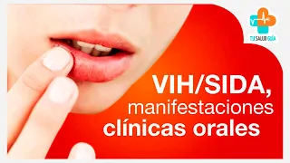 VIH/SIDA Manifestaciones clínicas bucales | Tu Salud Guía