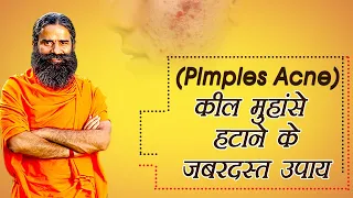 कील – मुहांसे (Pimples,Acne) हटाने के जबरदस्त उपाय | Swami Ramdev