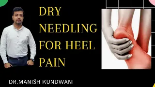 Dry Needling for Planter Fasciitis(Heel pain) #Shorts #drmanishkundwani #Midasphysiocare #Heelpain