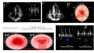 Cardiac amyloidosis : Multimodality assessment