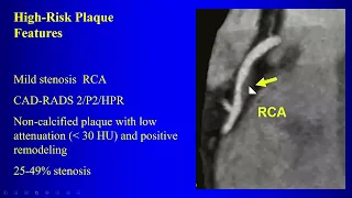 11ab CAD-RADS 2.0, evaluating coronary artery disease with CT, complications of infarction