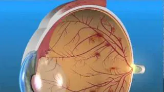 Proliferative Diabetic Retinopathy PDR