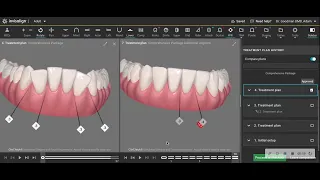 Actual before and after of Invisalign treatment needing refinement after first round of aligners