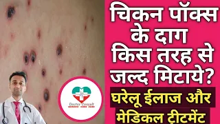 चिकन पॉक्स के दाग कैसे मिटाये? How To remove chicken pox black spots??